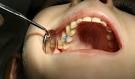 Лечение пульпита молочного зуба в Свободном